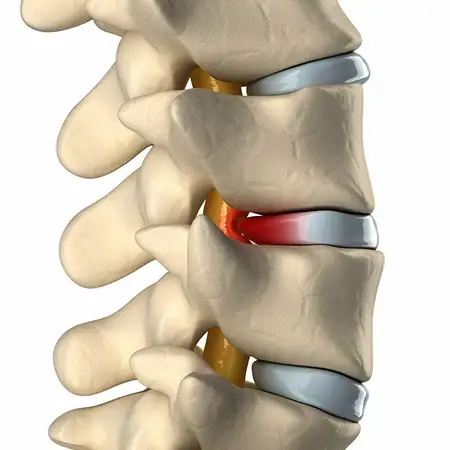 Herniated and bulging discs